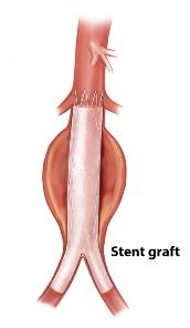 Diagram of a stent graft placement in the aorta