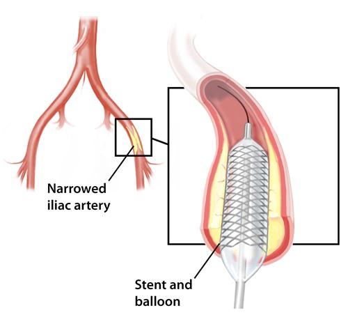 Diagram of stent placement
