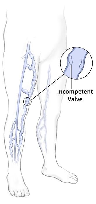 Diagram showing varicose veins in the leg