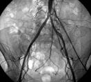 Iliac Stenosis Angiography