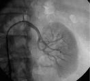 Renal Angiography Using 5F Catheter