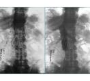 Inferior Vena Cava Filter Placement