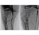 Plaque Excision