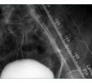 Stent Deployment