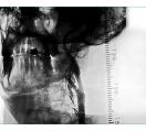 Carotid Stenting 