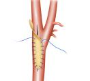 Carotid Partially Patched