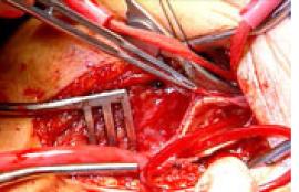 Pruitt Shunt in surgery