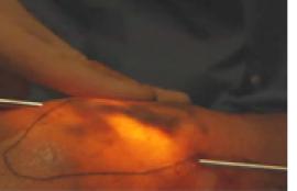 Transilluminated Powered Phlebectomy