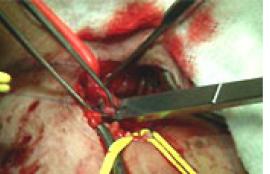 AnastoClips being applied to vessel