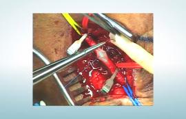Creating an anastomosis with ProCol