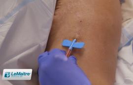 Cannulation of Artegraft