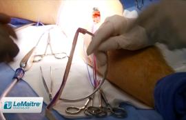 Artegraft Implantation