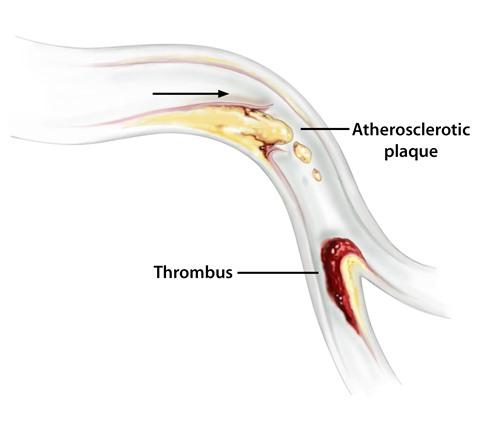 Diagram of a blood vessel showing plaque an thrombus