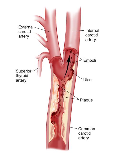 Diagram of Carotid Artery 