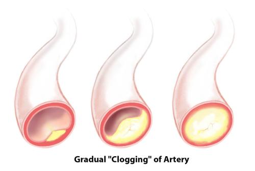 Illustration showing gradual clogging of arteries