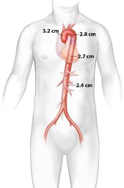 Diagram showing aorta sizes