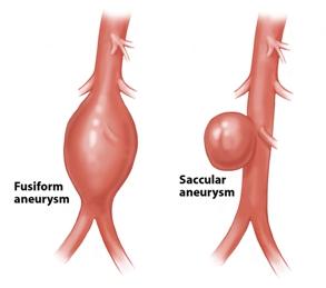 Diagram of Fusiform and Sacular Anuerysms