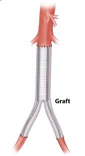 Diagram showing a polyester bifucated graft