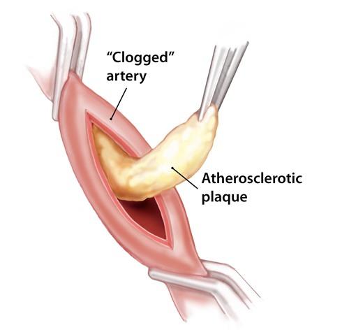 Endarterectomy