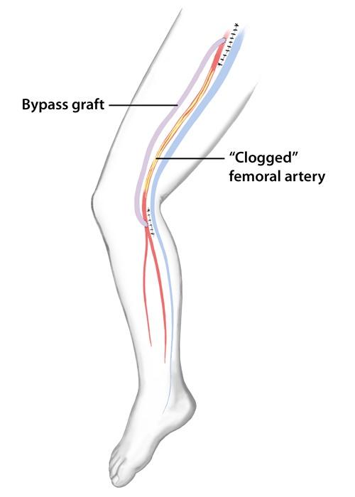 Bypass Grafting