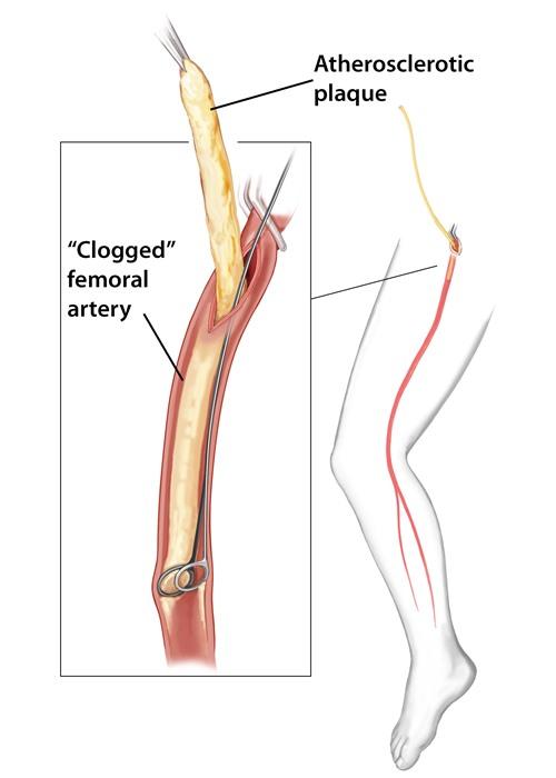 Remote Endarterectomy