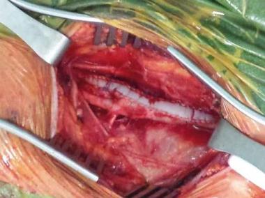 Surgery showing patch in vessel