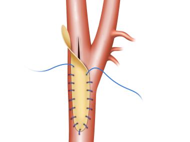 Carotid Partially Patched
