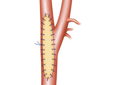 VascuCel Bioscaffold