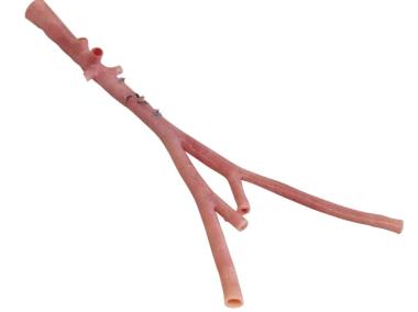 RestoreFlow Aortoiliac Allograft