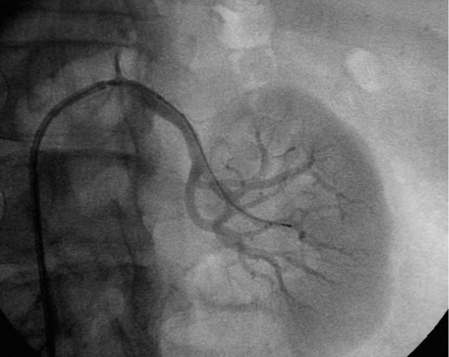Renal Angiography Using 5F Catheter