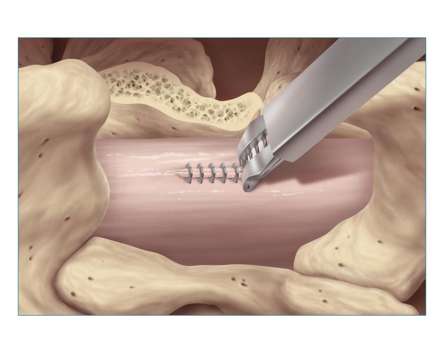 Clipped Dural Closure