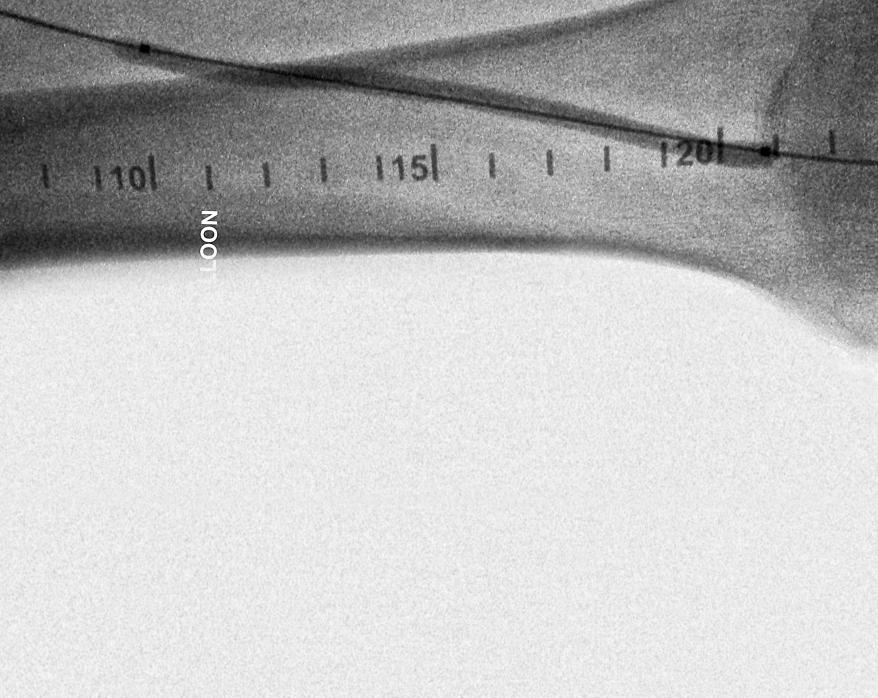 Percutaneous Transluminal Angioplasty (PTA)