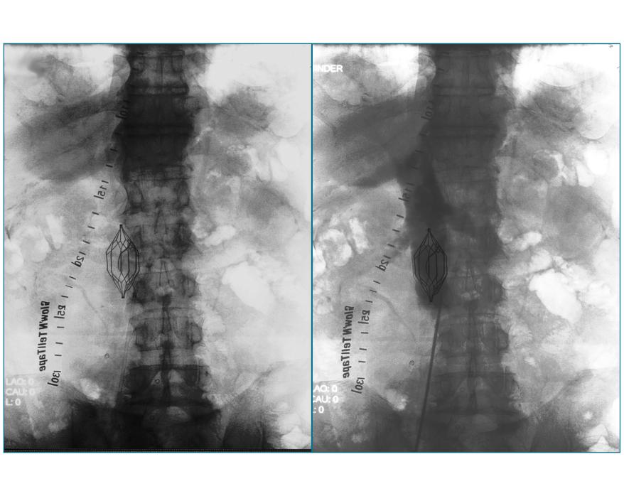 Inferior Vena Cava Filter Placement