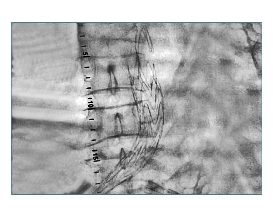 Stent Graft Placement