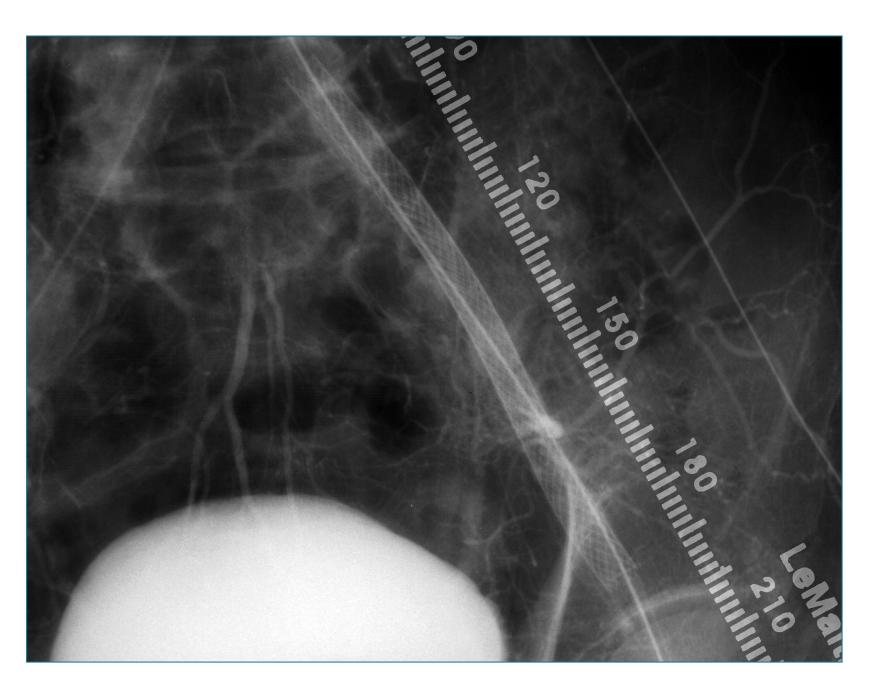 Stent Deployment