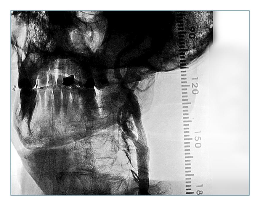 Carotid Stenting 