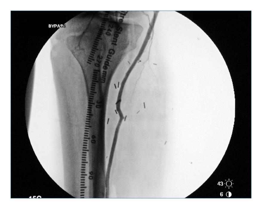 In Situ Bypass