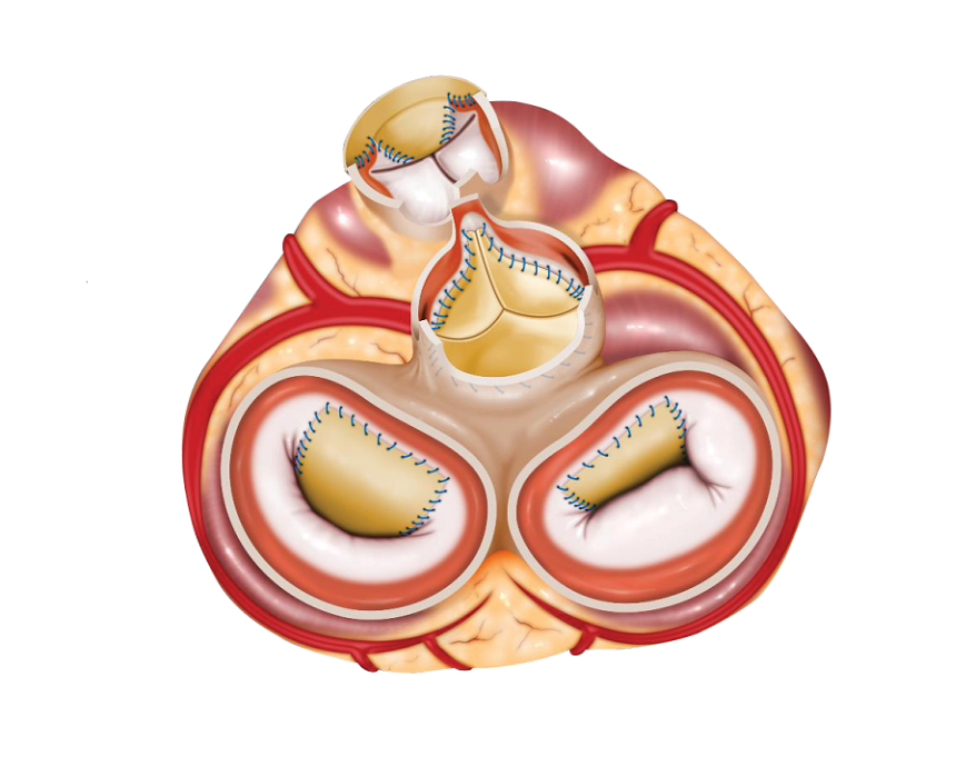 CardioCel Patched Heart - Interior View