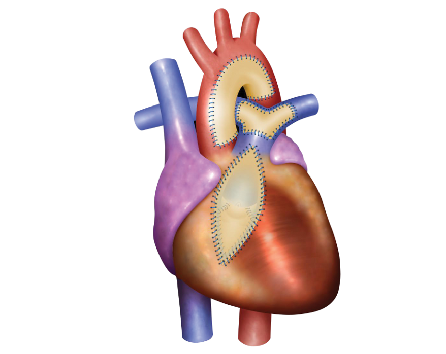 CardioCel Patched Heart