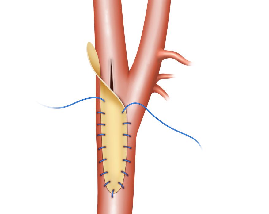 Carotid Partially Patched