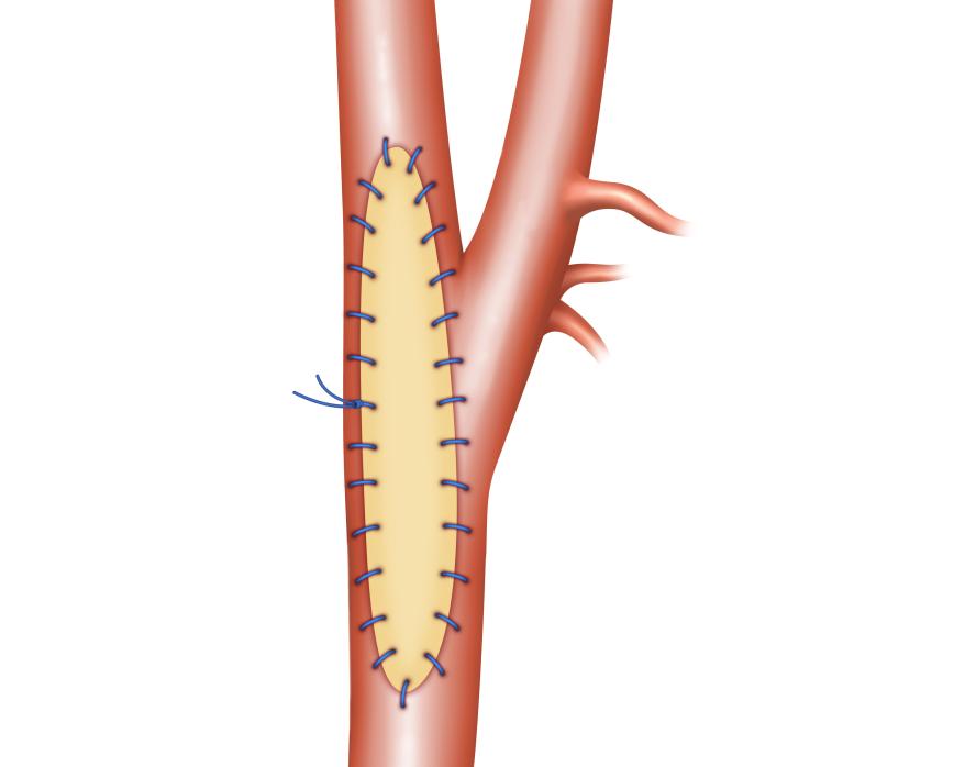 VascuCel Bioscaffold Patch